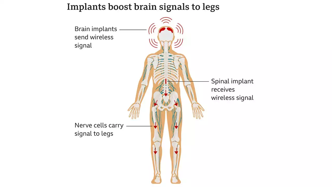Brain Implants Helped Paralysed Man to Walk Again