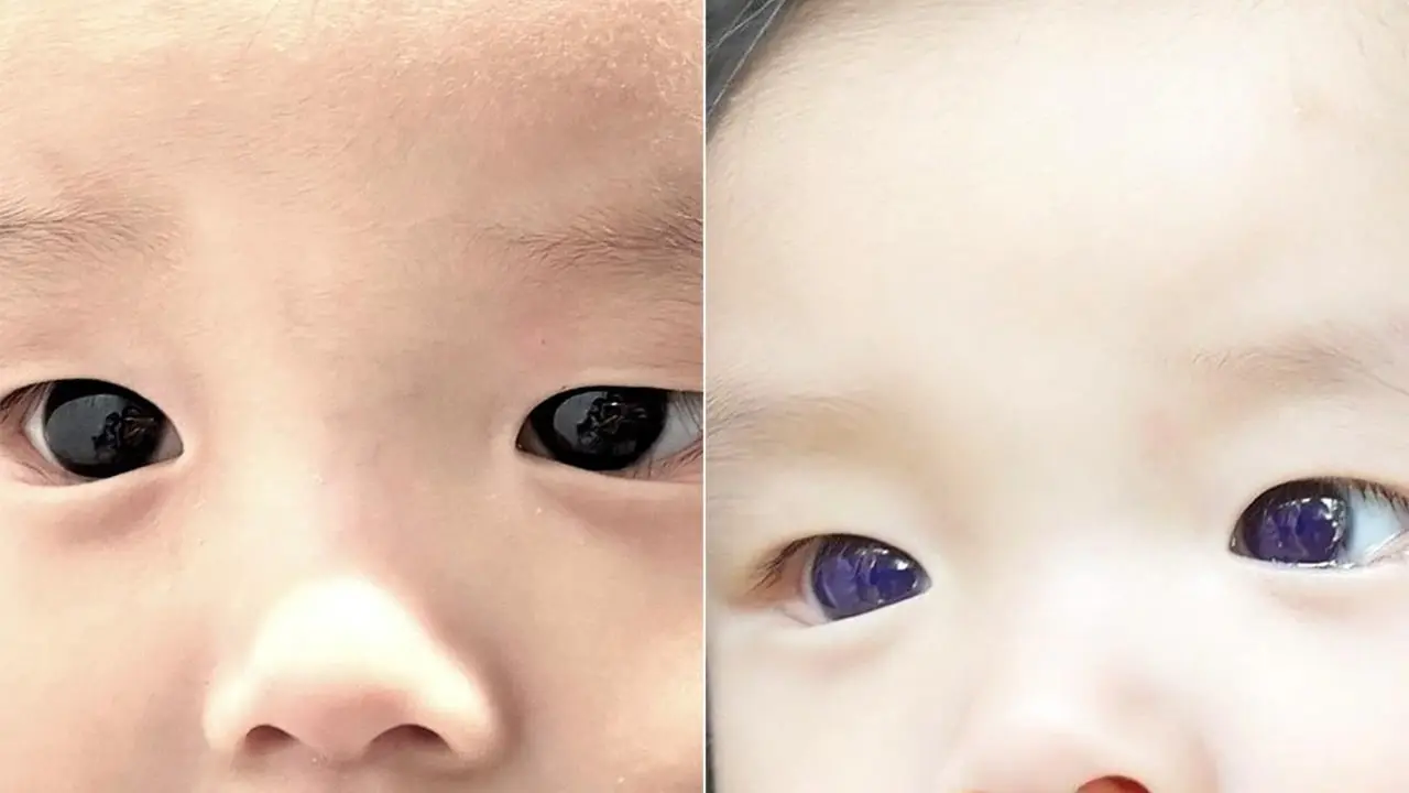 Thai Baby's Eyes Change from Brown to Blue After COVID-19 Treatment.